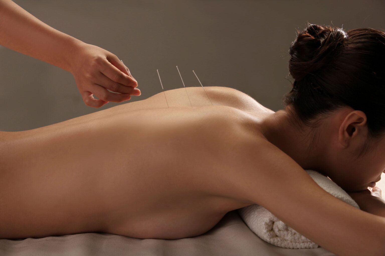 Woman laying on her stomach with acupuncture needles in back
