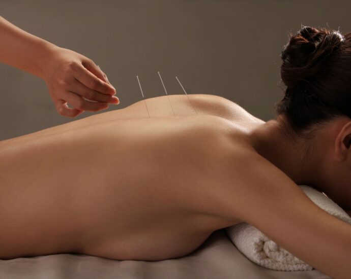 Woman laying on her stomach with acupuncture needles in back